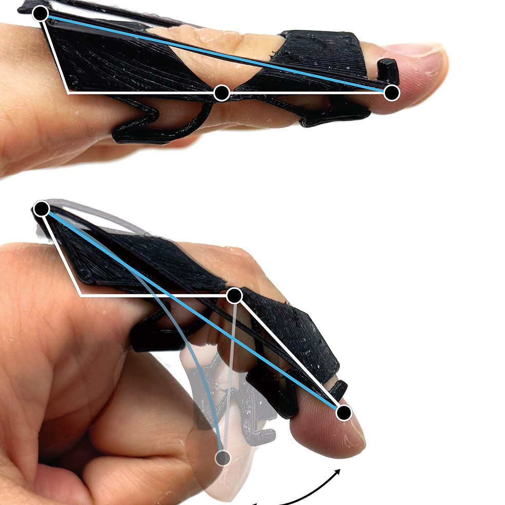 Personalized Bistable Orthoses for Rehabilitation of Finger Joints